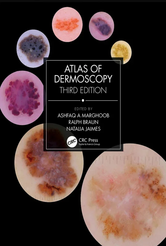 Atlas of Dermoscopy 3rd Edition