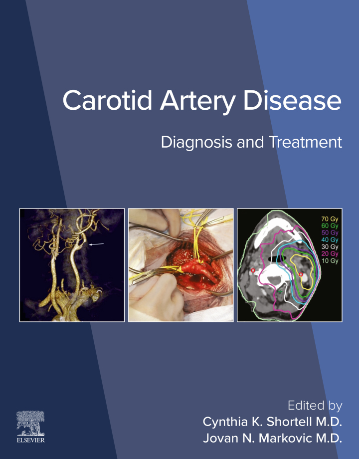 Carotid Artery Disease: Diagnosis and Treatment